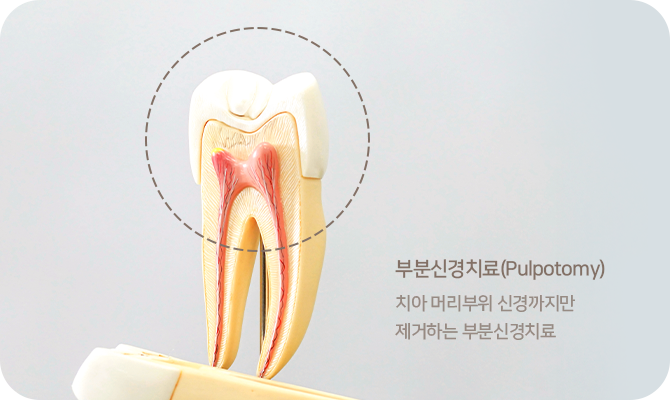 신경치료사진